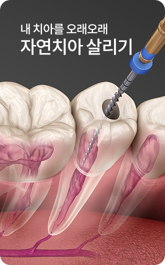 자연치아살리기